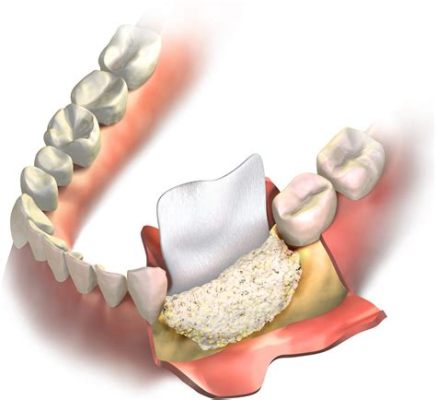  Dentatin: ยารักษาโรคฟันที่สามารถสร้างกระดูกใหม่ได้จริงหรือ?!